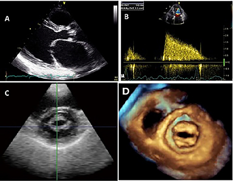 Understanding the role of echocardiography in the assessment of mitral